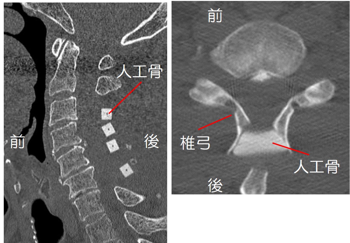 【椎弓形成術後のＣＴ写真】