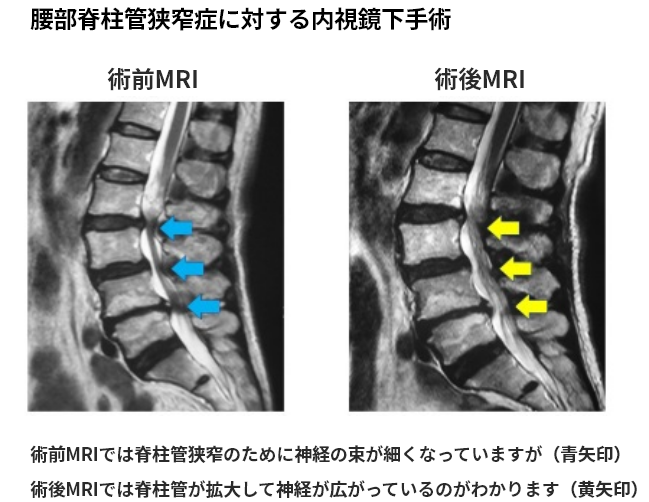 低侵襲手術 脊椎内視鏡下手術 脊椎内視鏡 肩 股 膝の関節鏡 人工関節の低侵襲手術なら和歌山市吉田の角谷整形外科病院