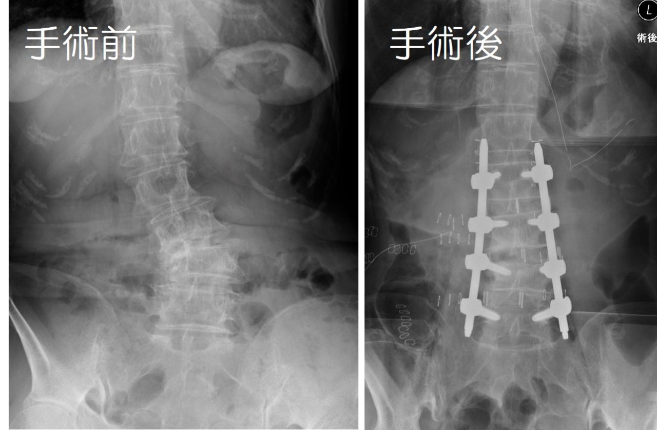 【変性側弯症に対する矯正固定術】