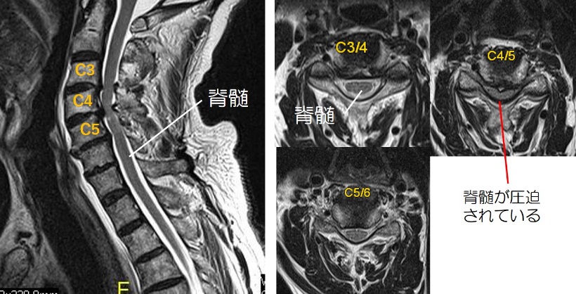 Mri 頚椎